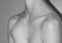 Междисциплинарный подход к лечению пациентов с pectus excavatum: кардиологи, пульмонологи, психологи