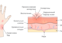 Контактный дерматит: причины, симптомы и методы ухода за кожей