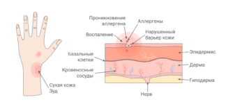 Контактный дерматит: причины, симптомы и методы ухода за кожей