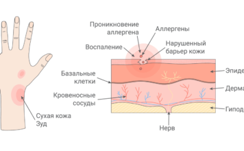 Контактный дерматит: причины, симптомы и методы ухода за кожей